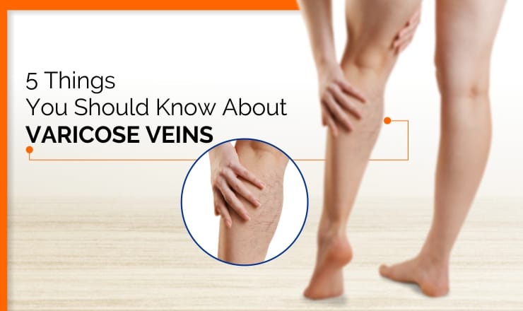 5 Things You Should Know About Varicose Veins