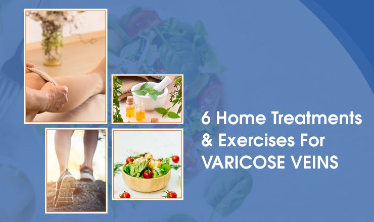 6 Home Treatments & Exercises For Varicose Veins