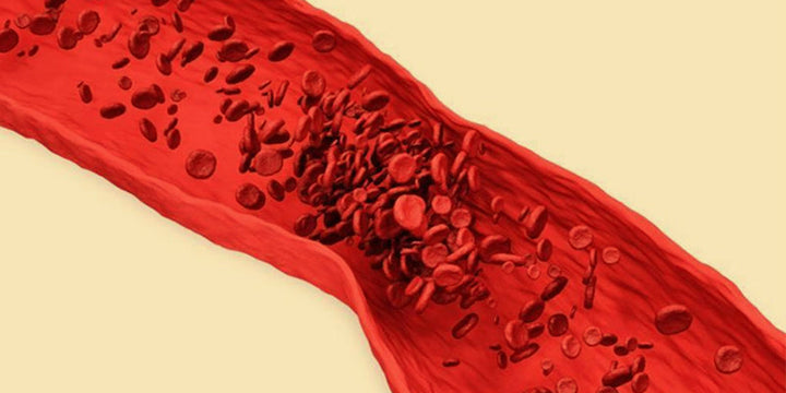 A Small Clot With Big Implications