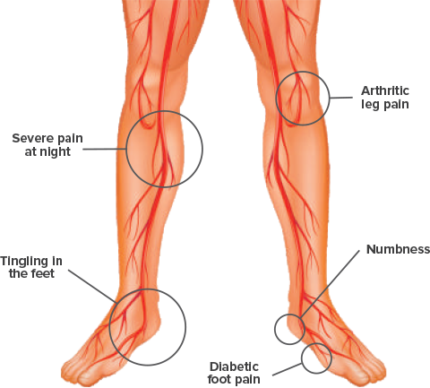 Foot Pulse ACU is benefited in severe pain at night, tingling in foot, diabetic foot pain, numbness & arthritic leg pain